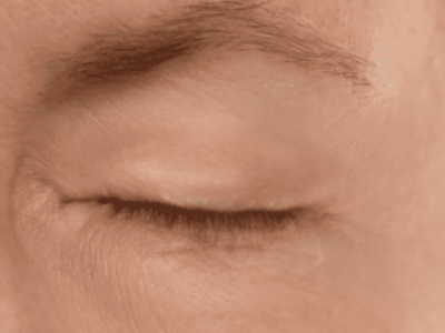 Blepharoplasty Surgery Surrey