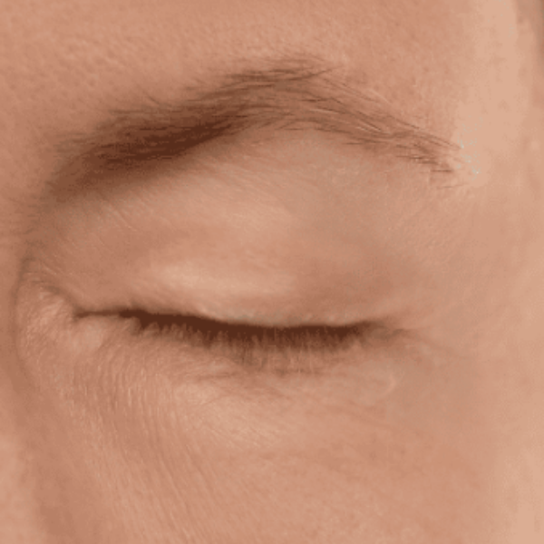 Blepharoplasty Surgery Surrey