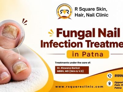 Expert Fungal Nail Infection Treatment in Patna