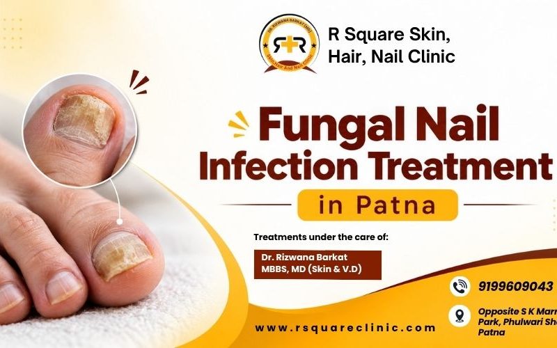 Expert Fungal Nail Infection Treatment in Patna