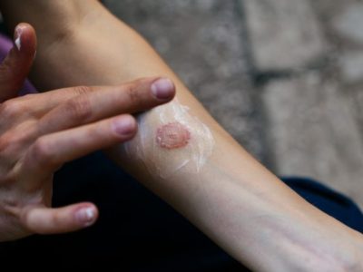 Topical Treatments for Skin Cancer