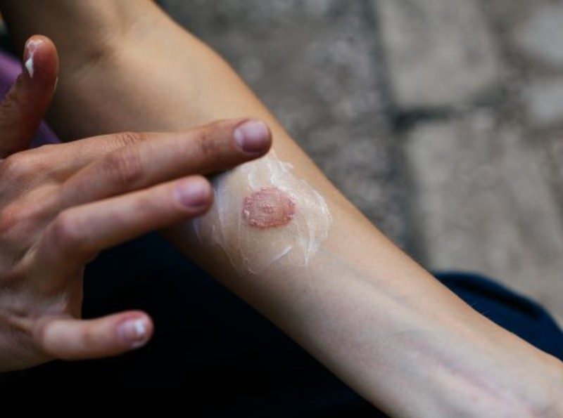 Topical Treatments for Skin Cancer