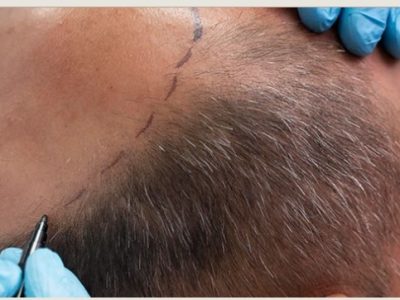 Hair Transplant Near DLF Phase Area, Gurgaon