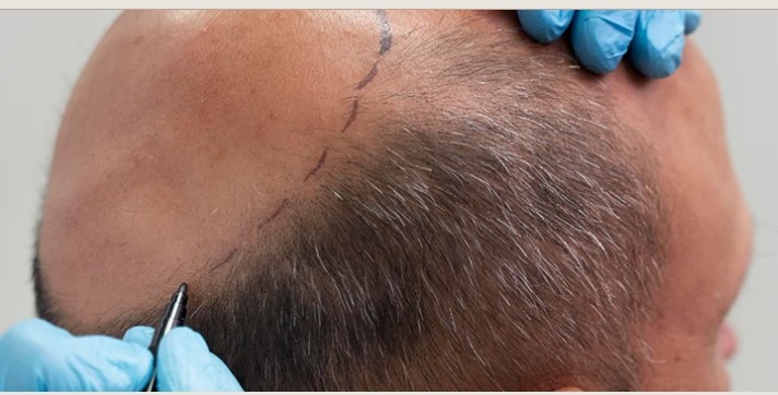 Hair Transplant Near DLF Phase Area, Gurgaon