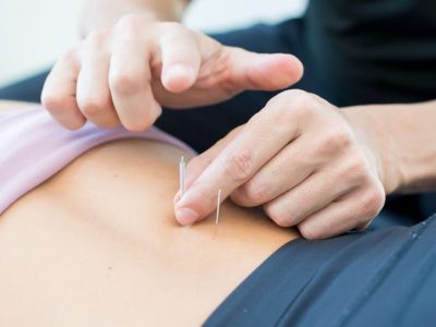 Dry Needling Hands-On Course for Chiropractors | Pulse Point Practice