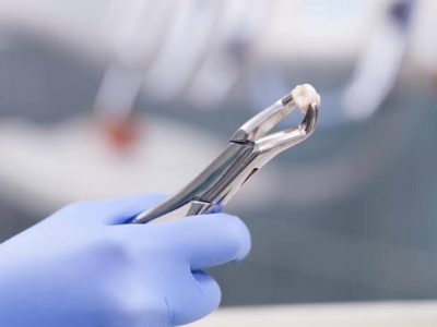 Tooth Extraction in West Hampstead