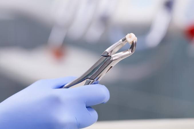 Tooth Extraction in West Hampstead