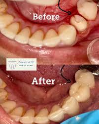 How Can Dental Fillings in Mahanagar Support Better Oral Health?