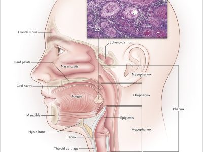 Best Head and Neck Cancer Treatment Expert in Noida | Cancer Consult