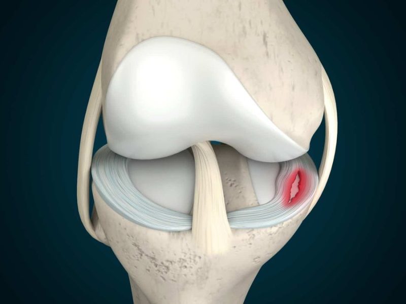 PRP Therapy for Meniscus Tears in Bangalore | RegenOrthoSport