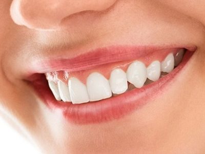 Dental Smile Makeover in Indore Dr Atul Jajoo