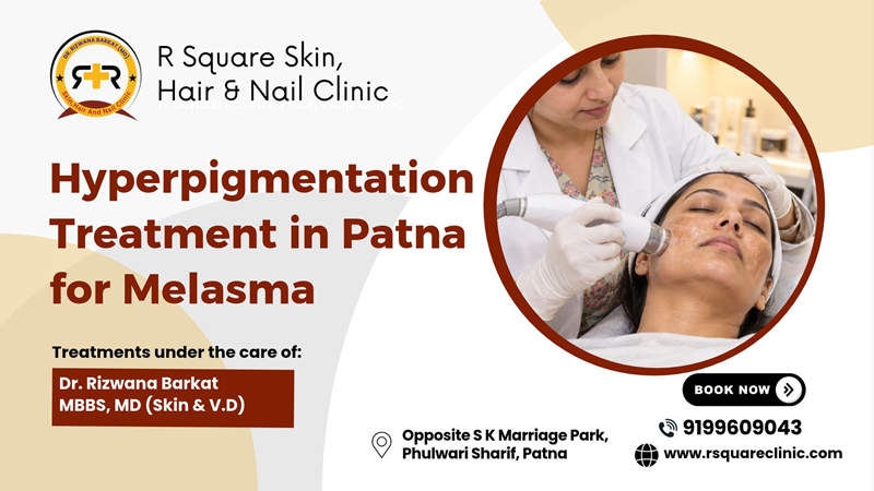 Hyperpigmentation Treatment in Patna for Melasma at R Square