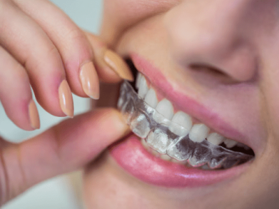 Invisalign vs braces Richmond – Find the Right Way to Straighten Your Smile