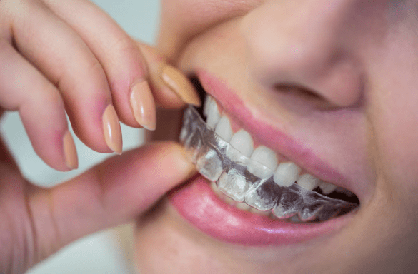 Invisalign vs braces Richmond – Find the Right Way to Straighten Your Smile