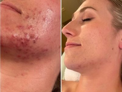 Personalized Skincare Treatments in Denver