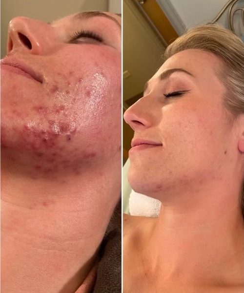Personalized Skincare Treatments in Denver