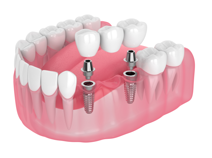 Porcelain veneers Harley Street